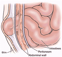 http://www.siamhealth.net/public_html/Disease/GI/gi/hernia.gif